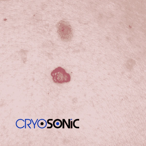 Looking for pain free cherry angioma removal treatment Waltham-Abbey? Call our team today! Waltham-Abbey