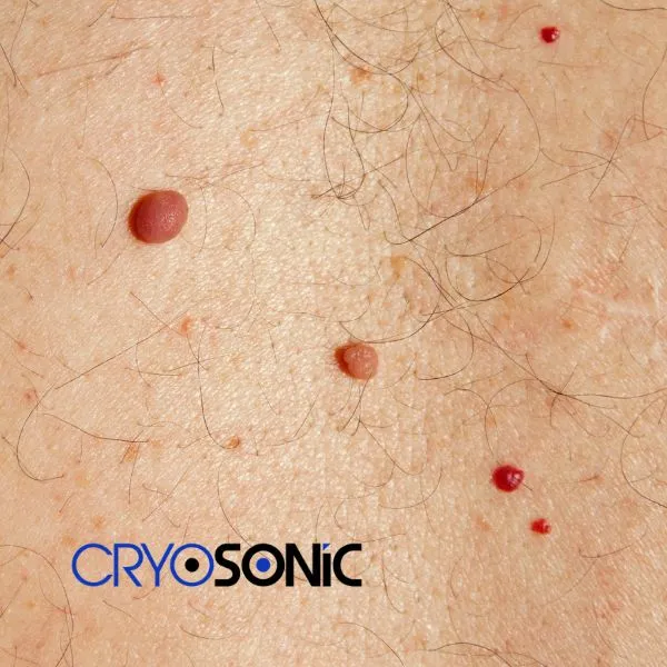 get cherry angioma removal treatment today! Waltham-Abbey