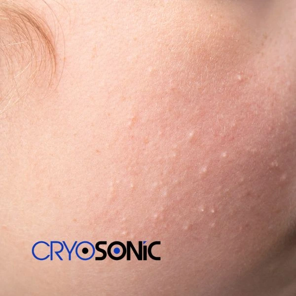 Are you looking for milia removal treatment? Contact our team today Waltham-Abbey