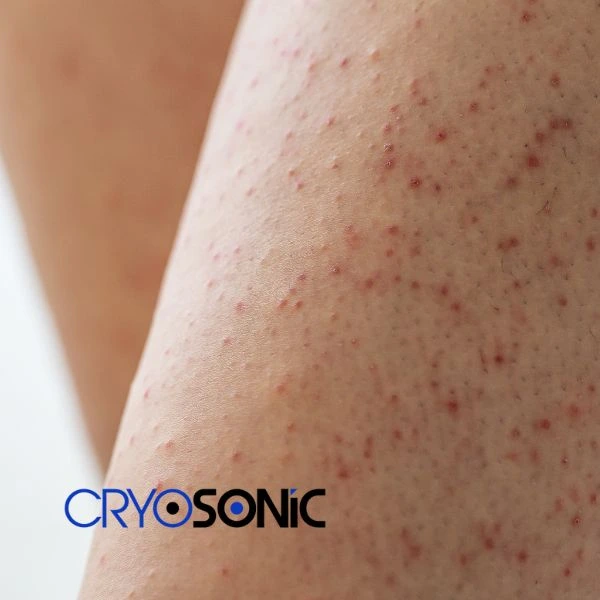 Looking for Seborrhoeic Keratosis removal Waltham-Abbey treatment? Call our consultants today in Waltham-Abbey