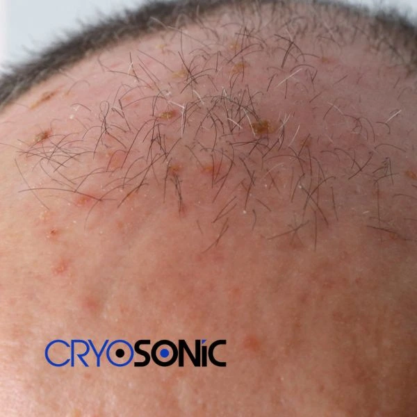 Access Seborrhoeic Keratosis removal from the comfort of your own home! Call us today in Waltham-Abbey