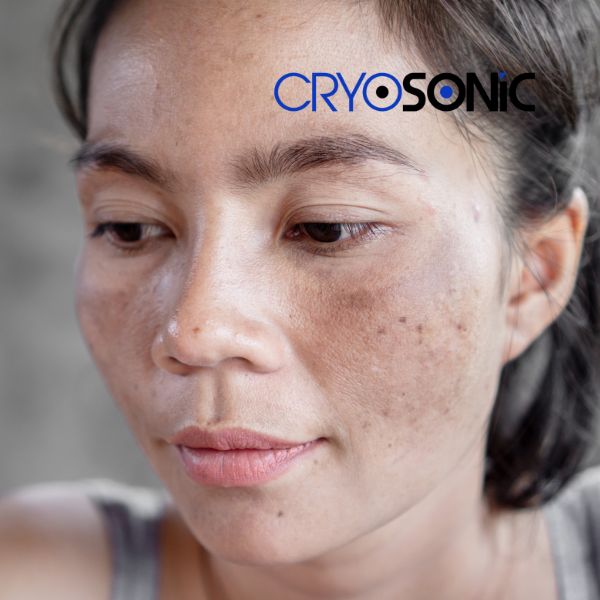 Ready to start age spots removal? Contact our team today in Waltham-Abbey