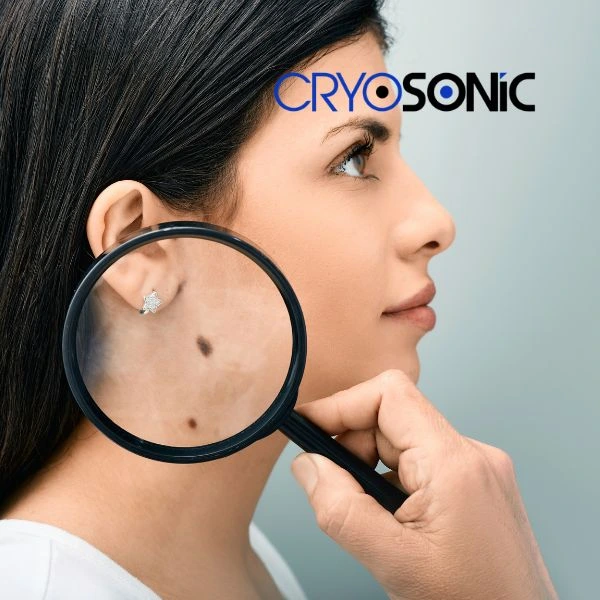 Do you want to learn more about benign moles removal treatment? Call our team today Waltham-Abbey