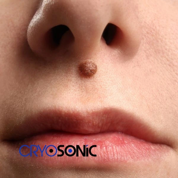Start your benign moles removal treatment today Waltham-Abbey
