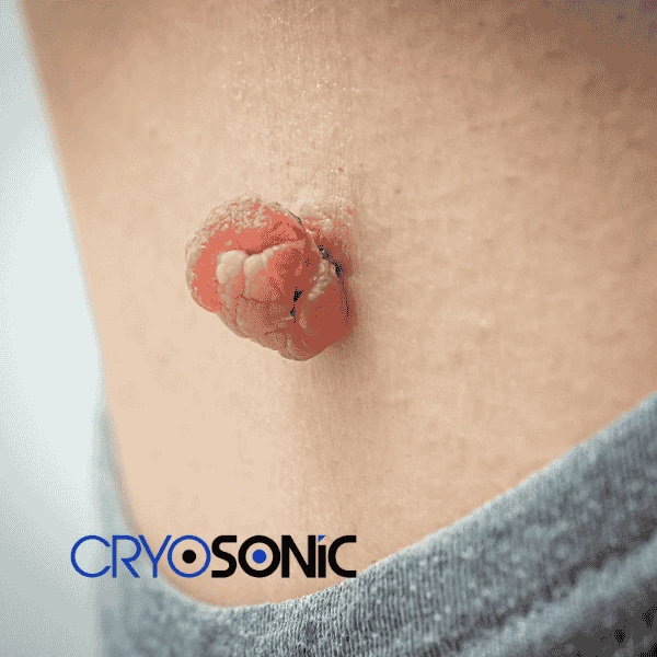 Book your skin tags removal Waltham-Abbey from comfort of your own home! Waltham-Abbey