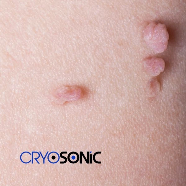 Are you looking for fast effect skin tag removal Waltham-Abbey? Book in NOW! Waltham-Abbey