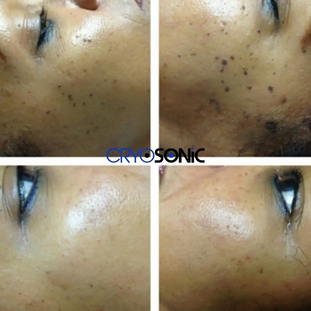 Why Skin Shows Pigmentation After Treatment Waltham-Abbey
