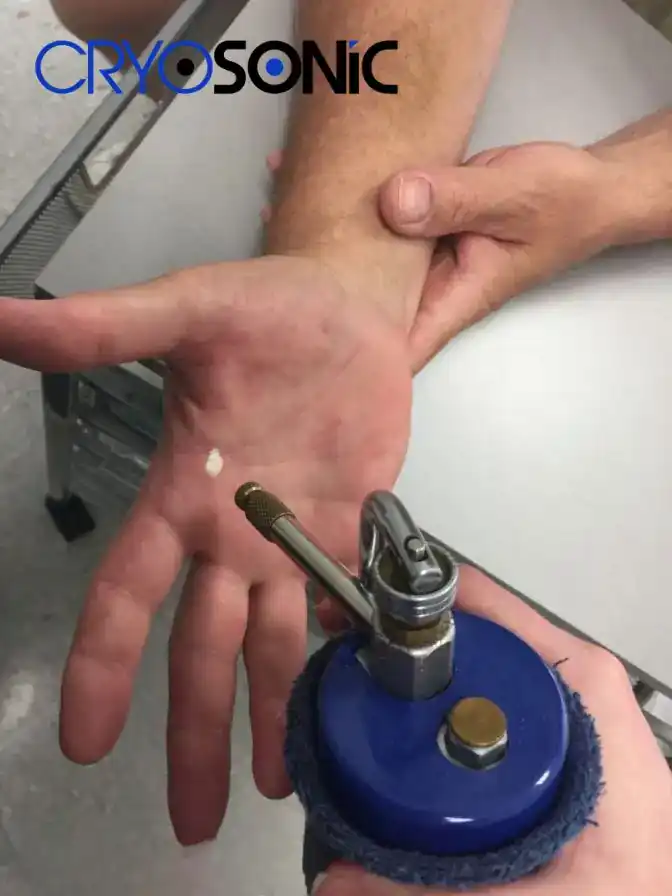 Temperature Differences: OTC vs Medical-Grade Cryotherapy Waltham-Abbey